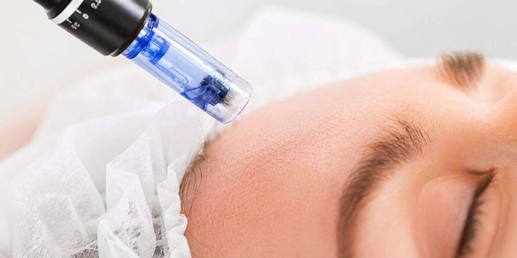 Microneedling Hair Loss Treatment Options